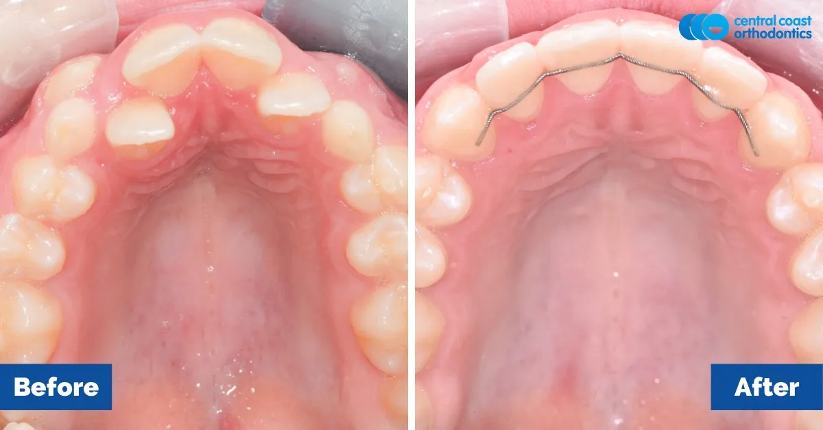 Before and after comparison, upper teeth viewed from below