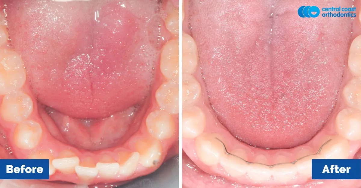 Before and after comparison, lower teeth viewed from above