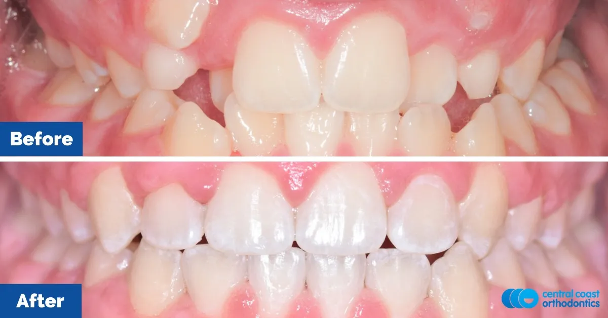 Before and after comparison, front view of the upper and lower teeth