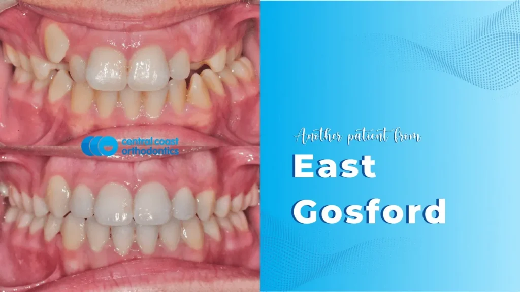 Before and after photographs of a Central Coast Orthodontics patient's teeth, labelled East Gosford