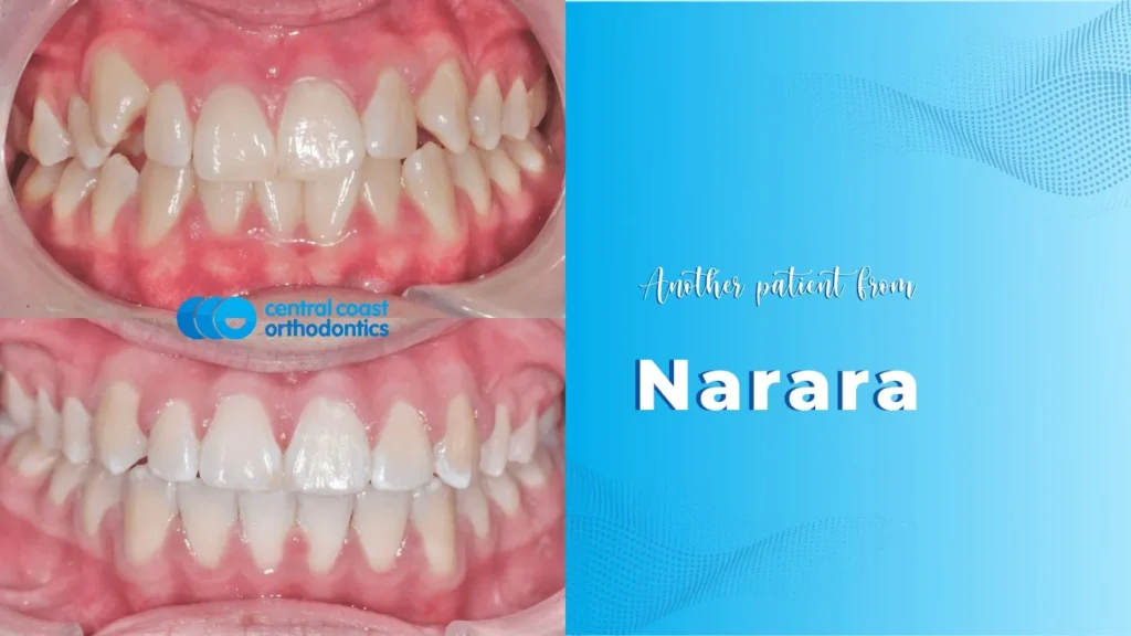 Before and after photographs of a Central Coast Orthodontics patient's teeth, labelled Narara