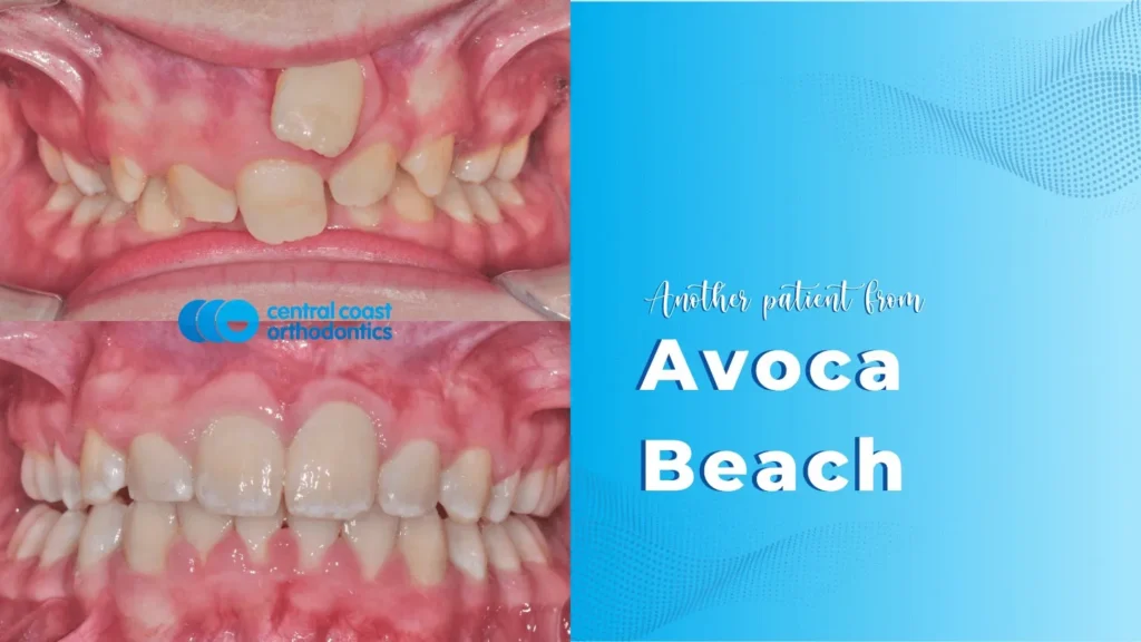 Before and after photographs of a Central Coast Orthodontics patient's teeth, labelled Avoca Beach
