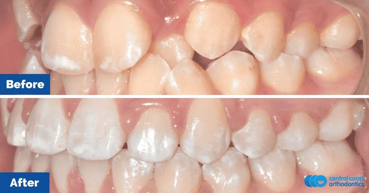 Before and after comparison, side view of the upper and lower teeth