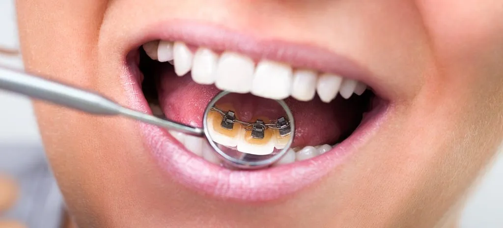 Dental mirror showing a lingual brace fitted to the back of the upper teeth