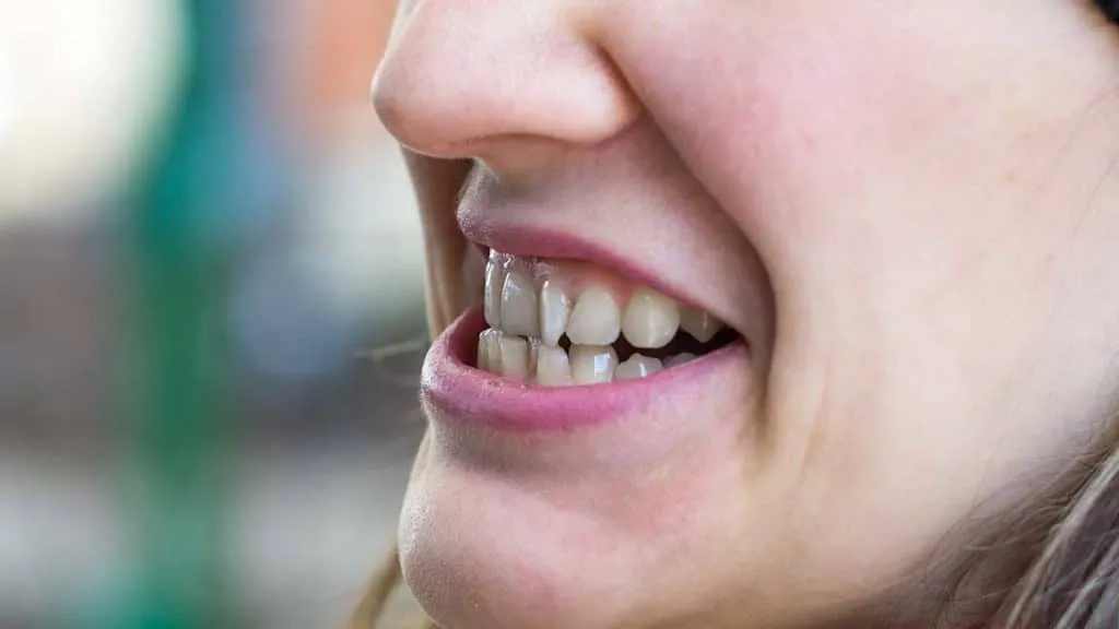 Close-up profile of a smile showing the upper and lower front teeth