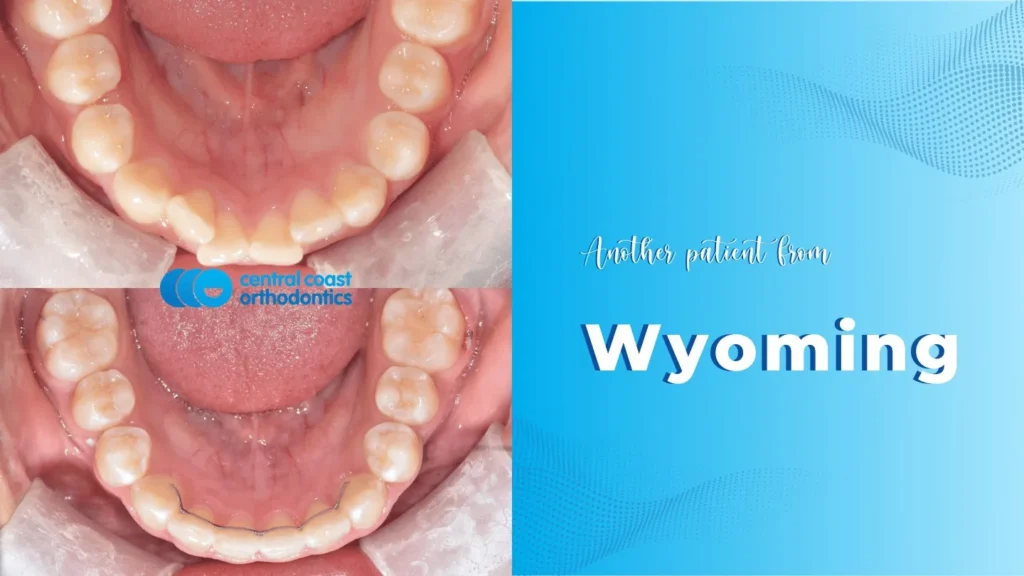 Before and after photographs of a Central Coast Orthodontics patient's teeth, labelled Wyoming