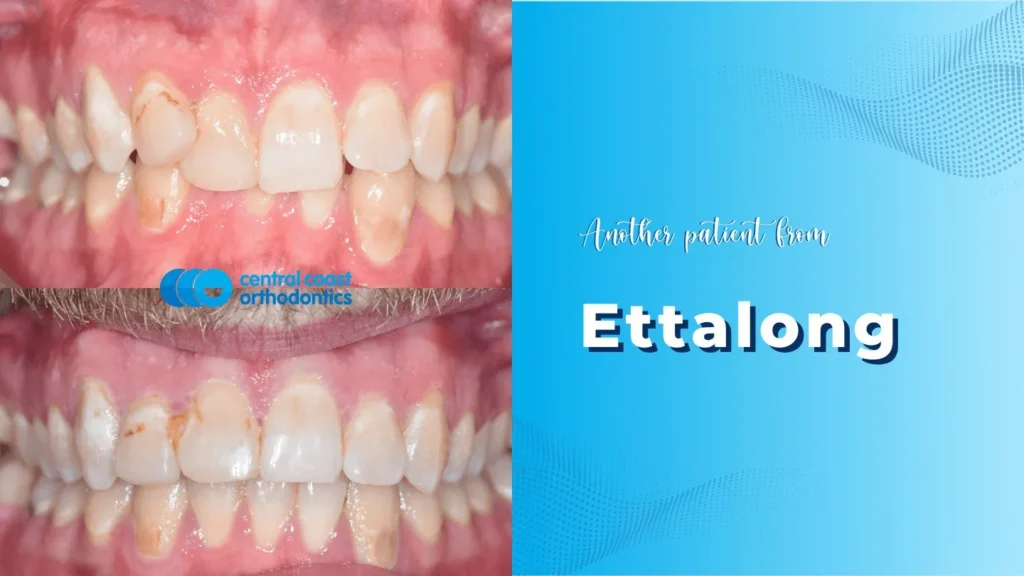 Before and after photographs of a Central Coast Orthodontics patient's teeth, labelled Ettalong
