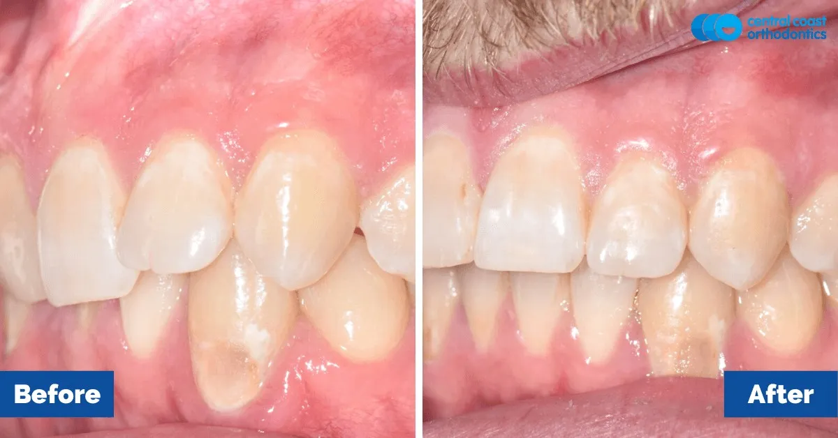 Before and after comparison, side view of the upper and lower teeth