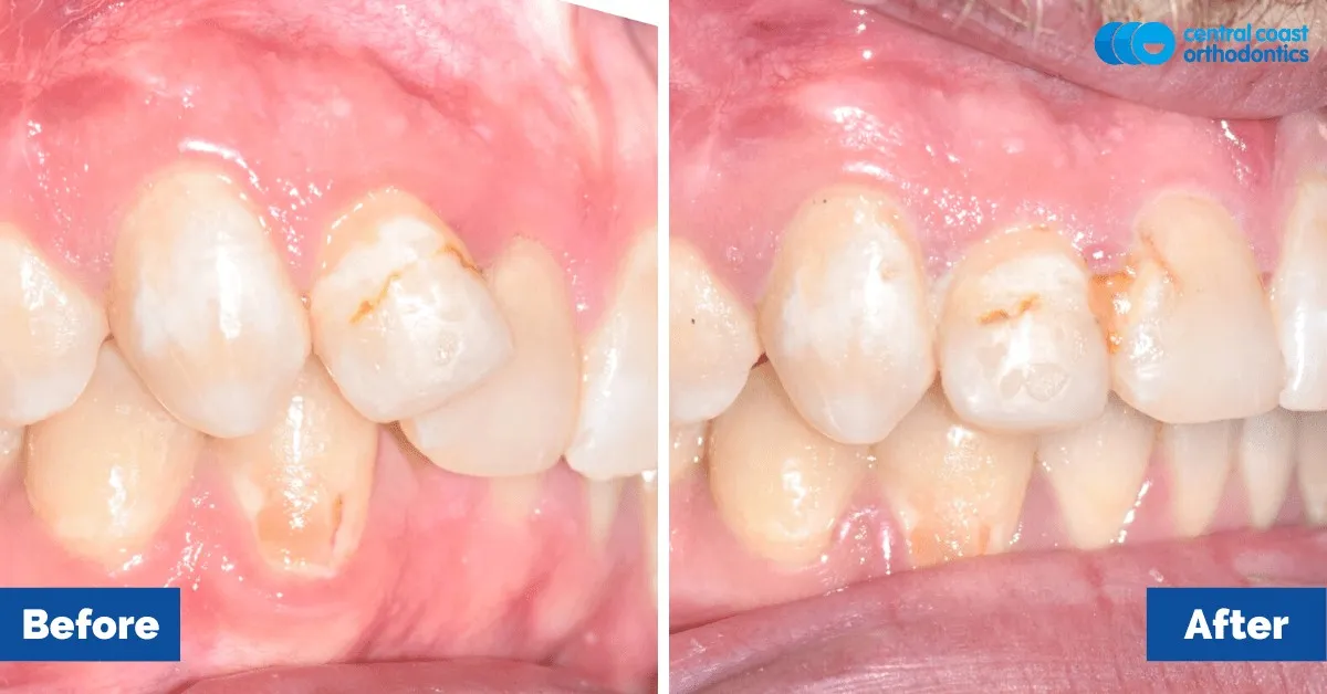 Before and after comparison, side view of the upper and lower teeth