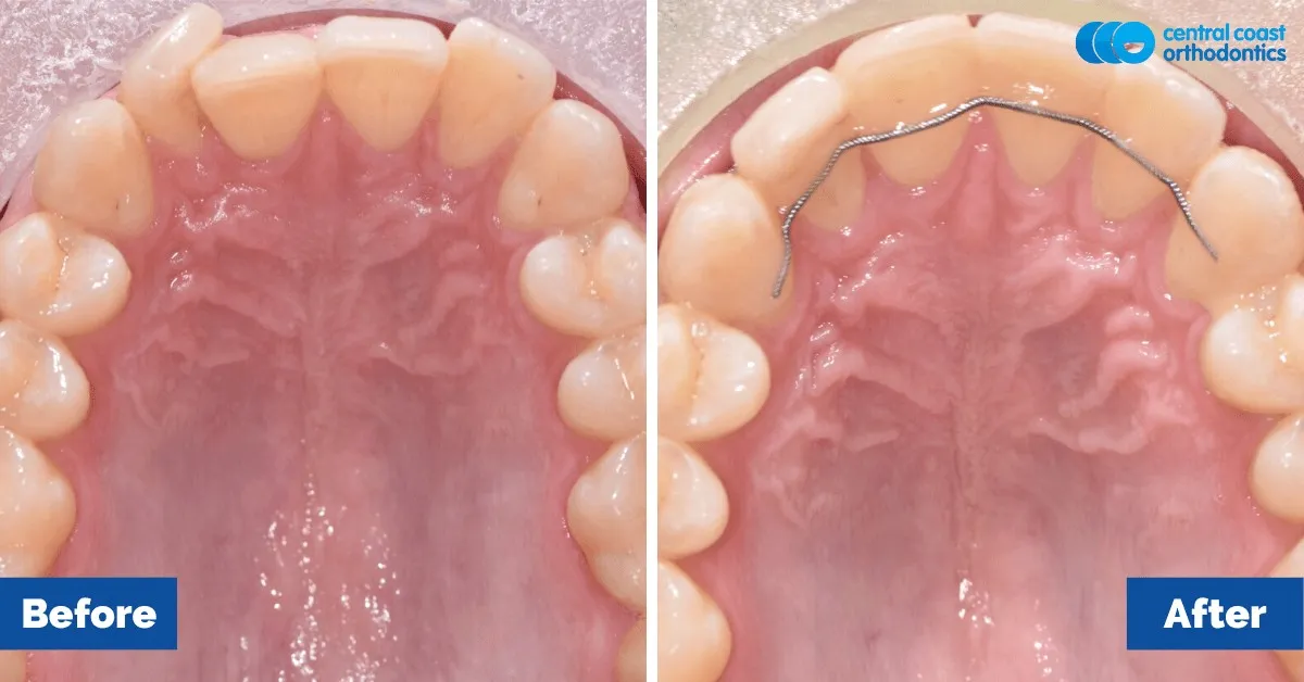 Before and after comparison, upper teeth viewed from below