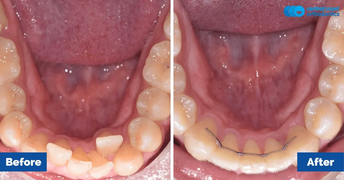 Before and after comparison, lower teeth viewed from above