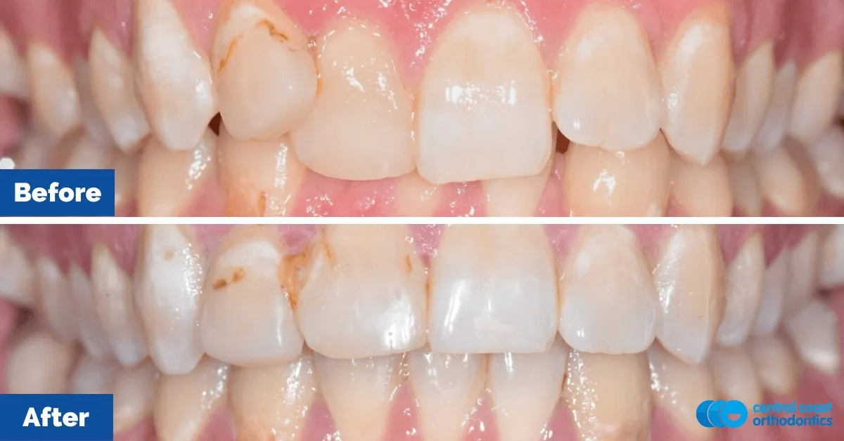 Before and after comparison, front view of the upper and lower teeth