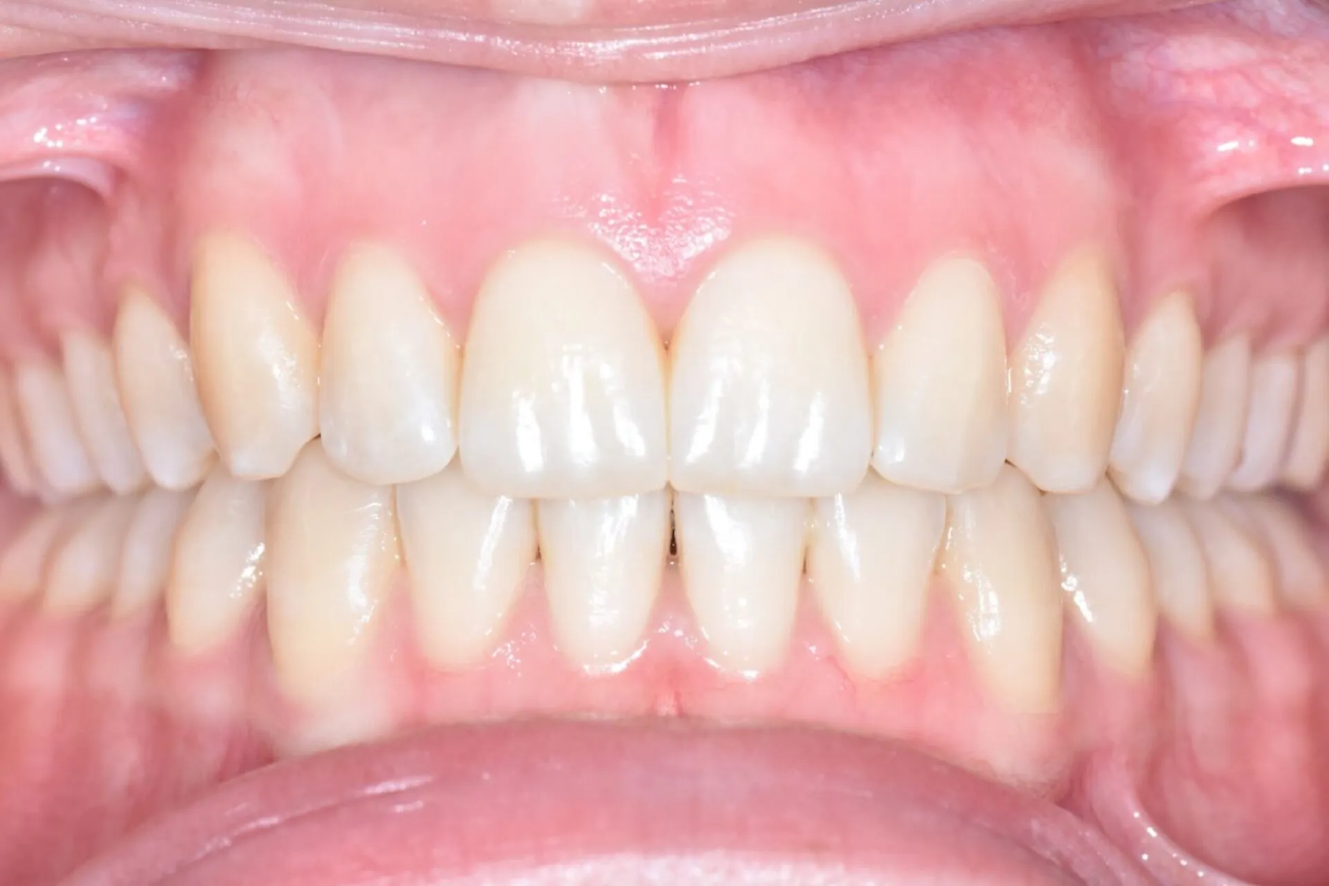 The same patient's front teeth evenly aligned after orthodontic treatment