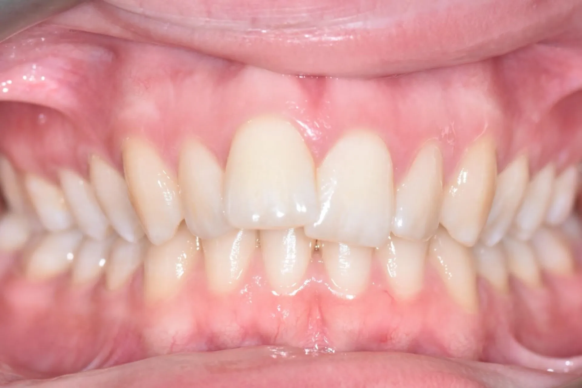 Close-up of uneven front teeth with an irregular bite before orthodontic treatment