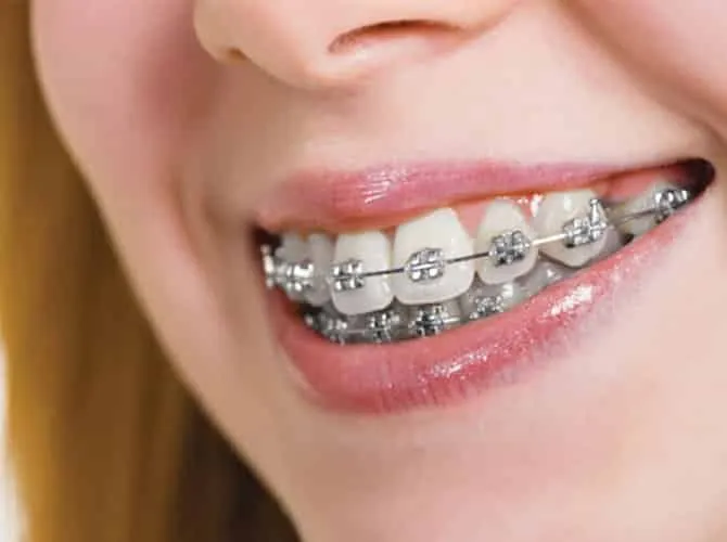 Close-up of a smile with metal braces
