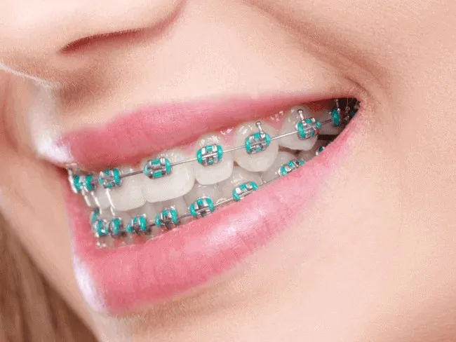 Metal Braces Does This Traditional Dental Technology Have a Future