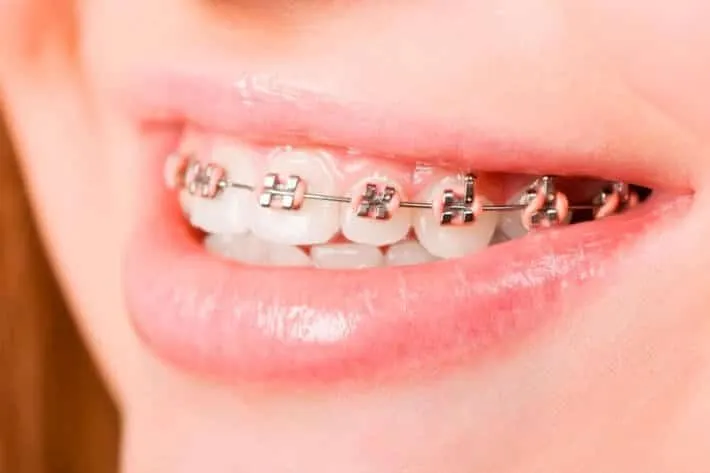 Close-up of a smile with braces and pink elastic ties