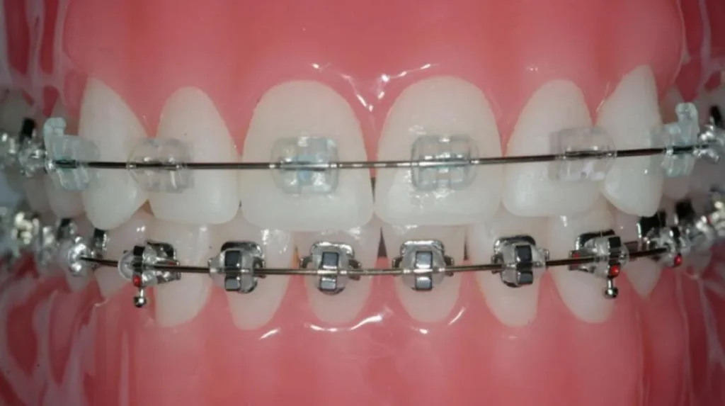 Close-up of metal braces fitted to the upper and lower teeth