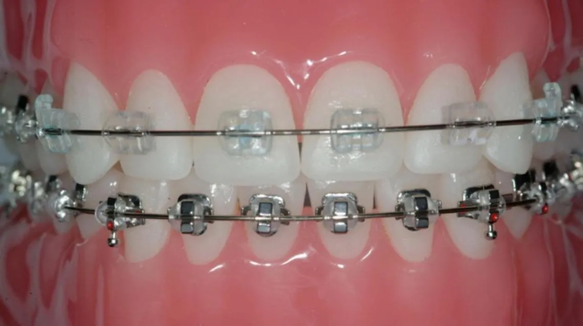 Close-up of metal braces fitted to the upper and lower teeth