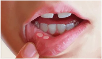 Close-up of a mouth with a gap where an upper front tooth is missing