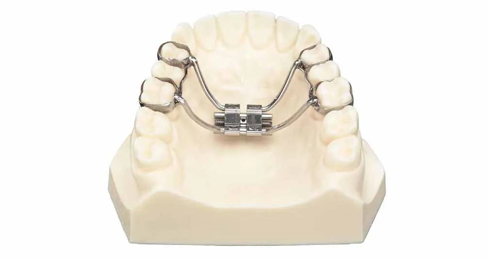 Dental model fitted with a removable palatal expander on the upper arch