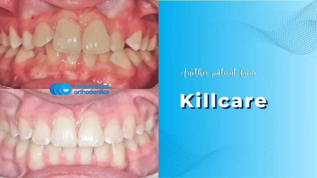 Before and after photographs of a Central Coast Orthodontics patient's teeth, labelled Killcare