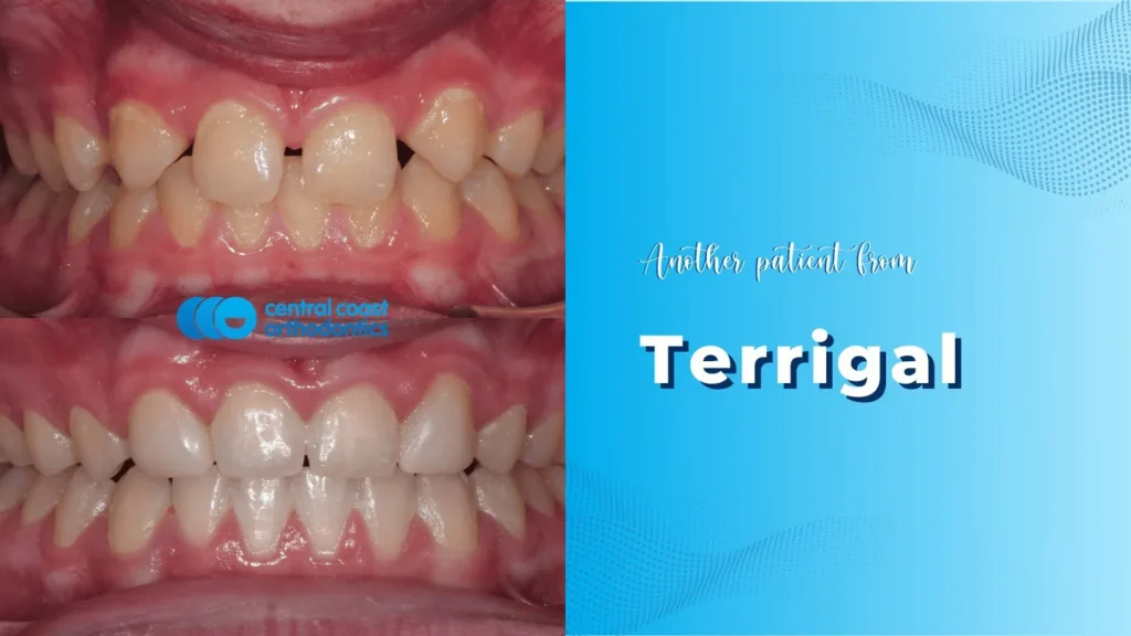 Before and after photographs of a Central Coast Orthodontics patient's teeth, labelled Terrigal