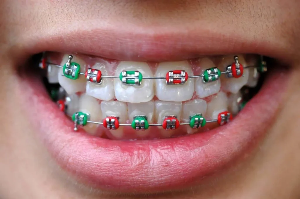 Close-up of a smile with braces and red and green elastic ties