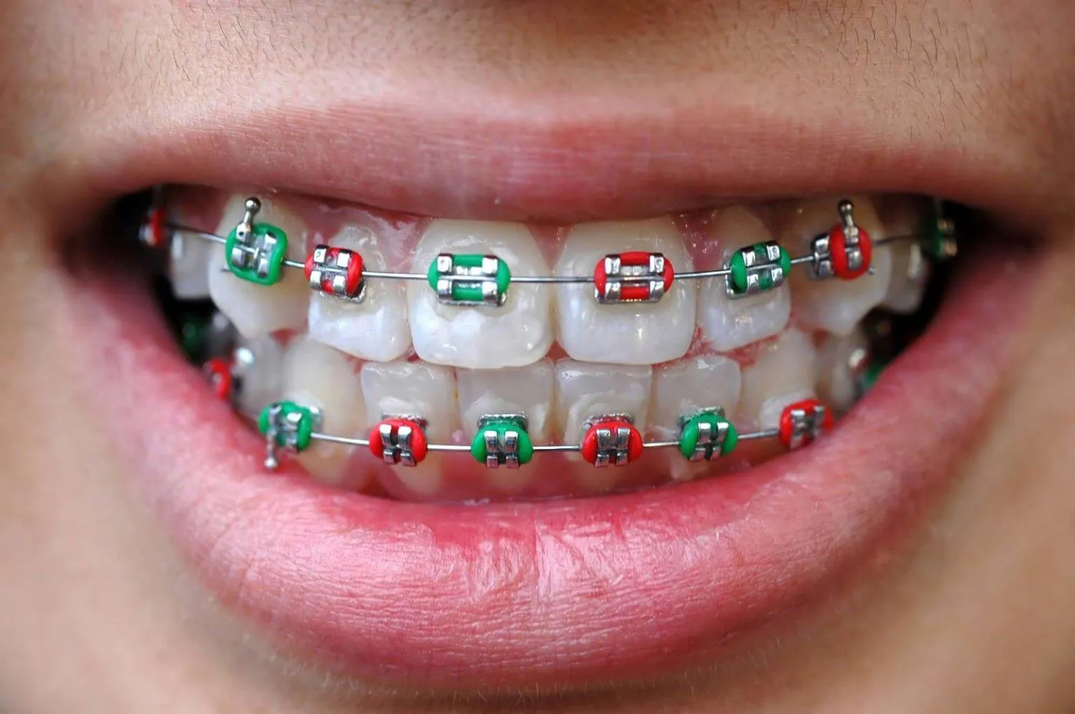 Close-up of a smile with braces and red and green elastic ties