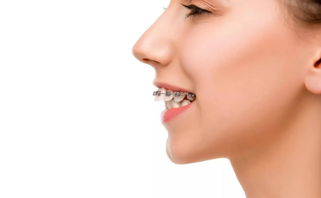 Side profile of a girl smiling with braces on her upper and lower teeth