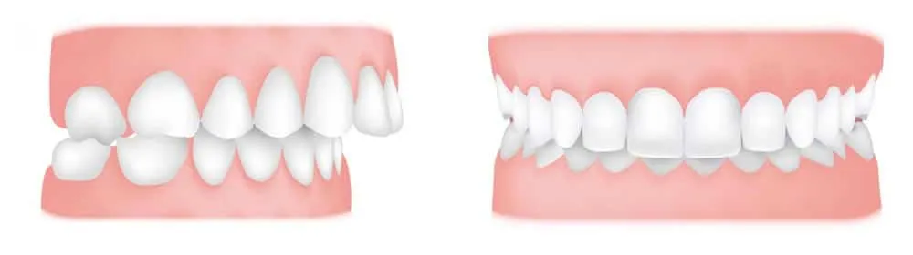 Two illustrations of dental arches comparing crowded teeth with evenly spaced teeth