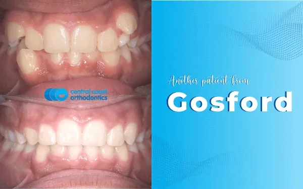 Before and after photographs of a Central Coast Orthodontics patient's teeth, labelled Gosford