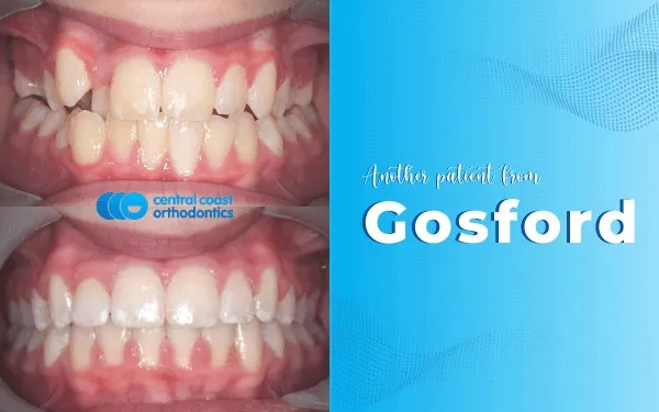 Before and after photographs of a Central Coast Orthodontics patient's teeth, labelled Gosford