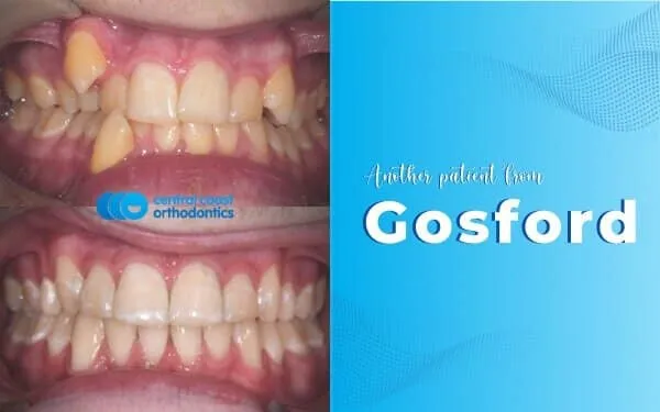 Before and after photographs of a Central Coast Orthodontics patient's teeth, labelled Gosford