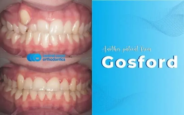 Before and after photographs of a Central Coast Orthodontics patient's teeth, labelled Gosford