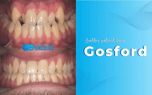 Before and after photographs of a Central Coast Orthodontics patient's teeth, labelled Gosford