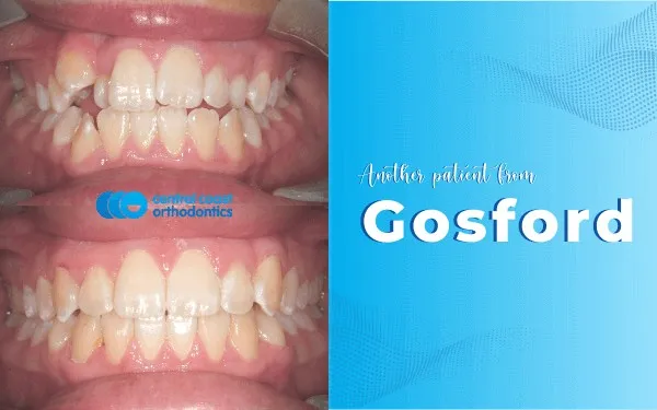 Before and after photographs of a Central Coast Orthodontics patient's teeth, labelled Gosford