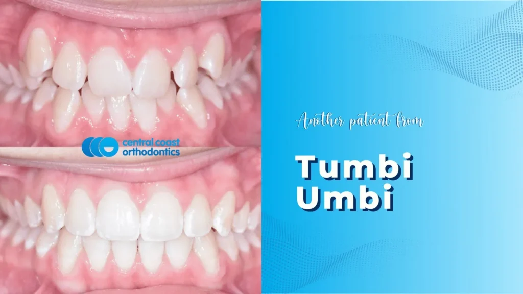 Before and after photographs of a Central Coast Orthodontics patient's teeth, labelled Tumbi Umbi