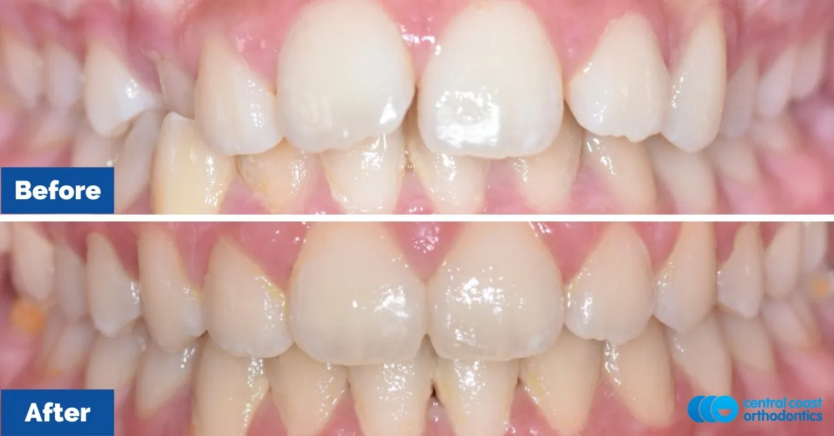 Before and after comparison, front view of the upper and lower teeth