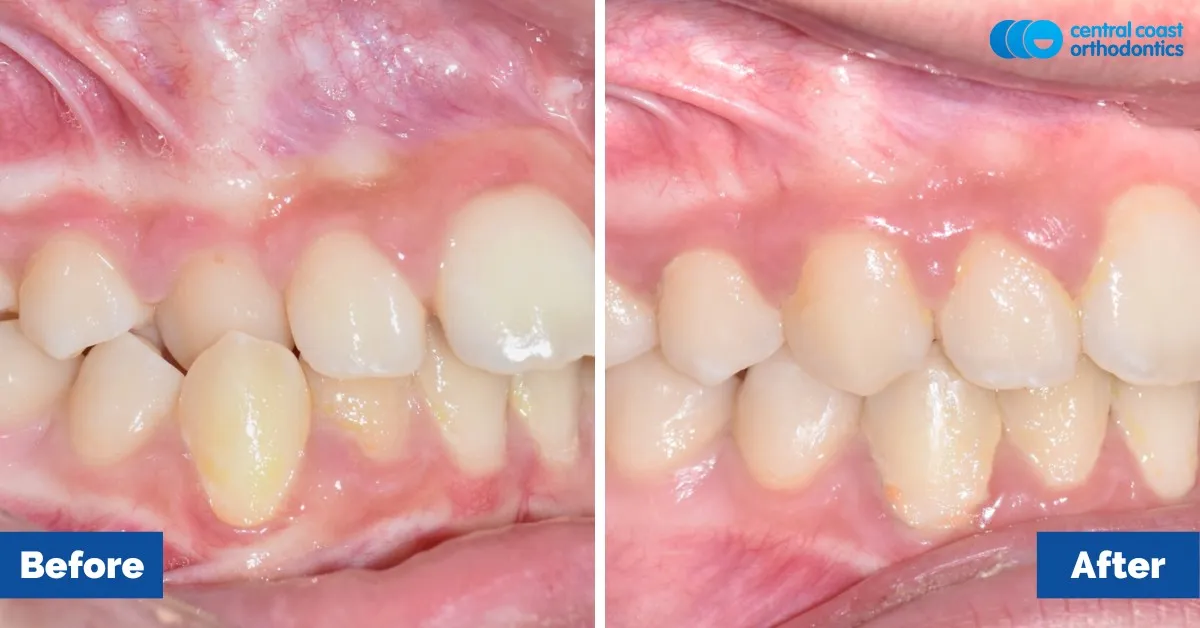 Before and after comparison, side view of the upper and lower teeth