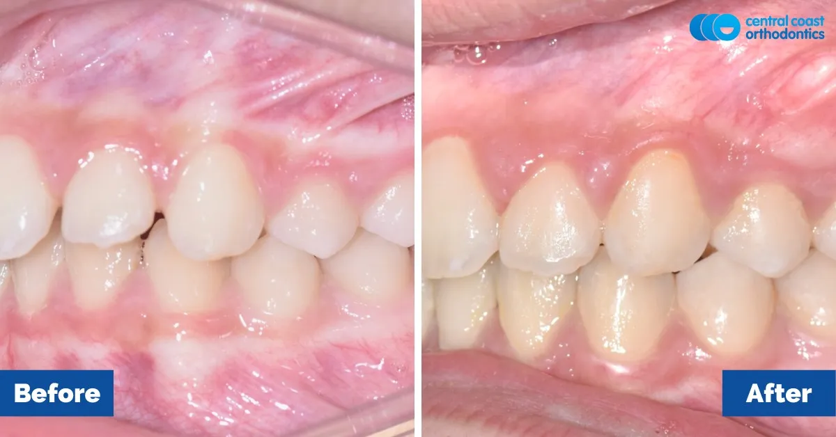 Before and after comparison, side view of the upper and lower teeth