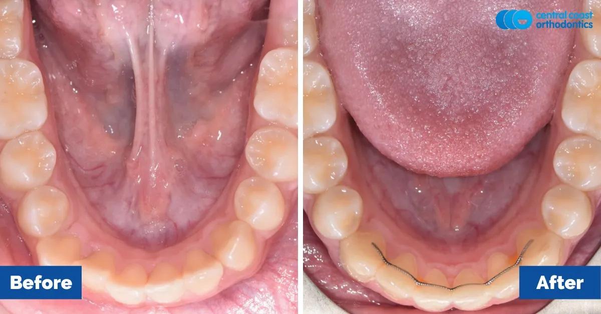 Before and after comparison, lower teeth viewed from above
