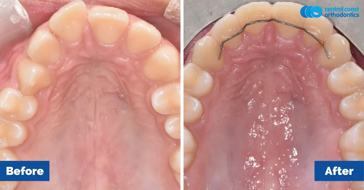 Before and after comparison, upper teeth viewed from below
