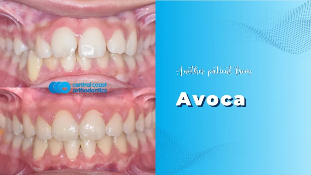 Before and after photographs of a Central Coast Orthodontics patient's teeth, labelled Avoca