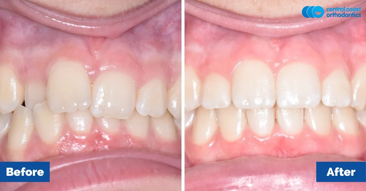 Before and after comparison, front view of the upper and lower teeth