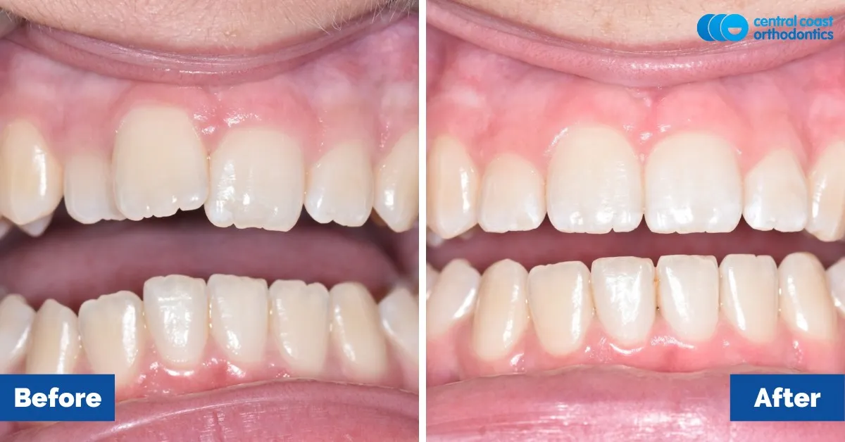Before and after comparison, front view of the upper and lower teeth