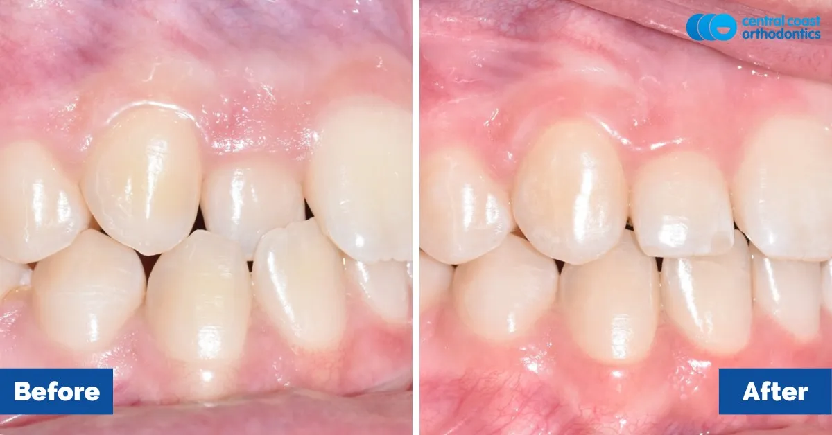 Before and after comparison, side view of the upper and lower teeth