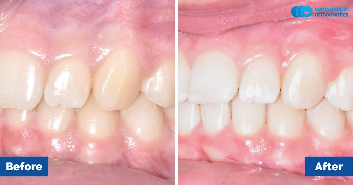 Before and after comparison, side view of the upper and lower teeth