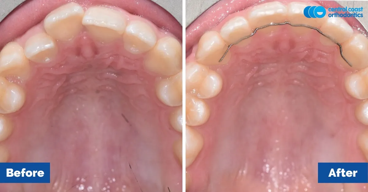 Before and after comparison, upper teeth viewed from below