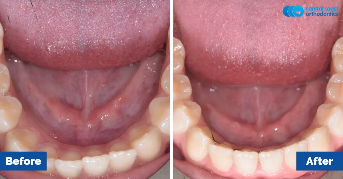 Before and after comparison, lower teeth viewed from above